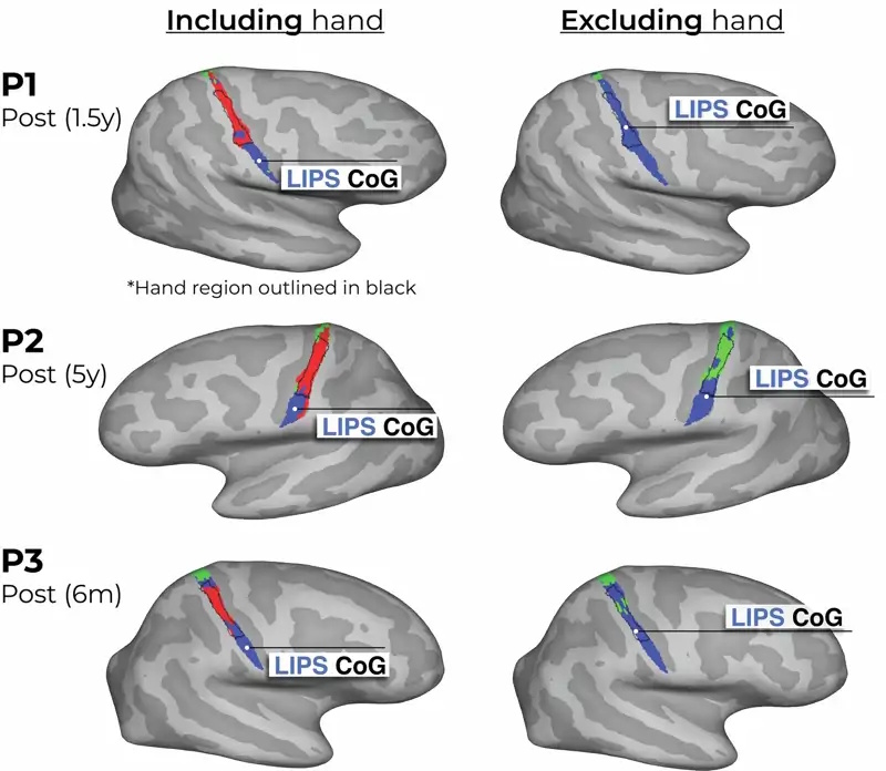5 resonancias incluyendo y excluyendo los miembros amputados